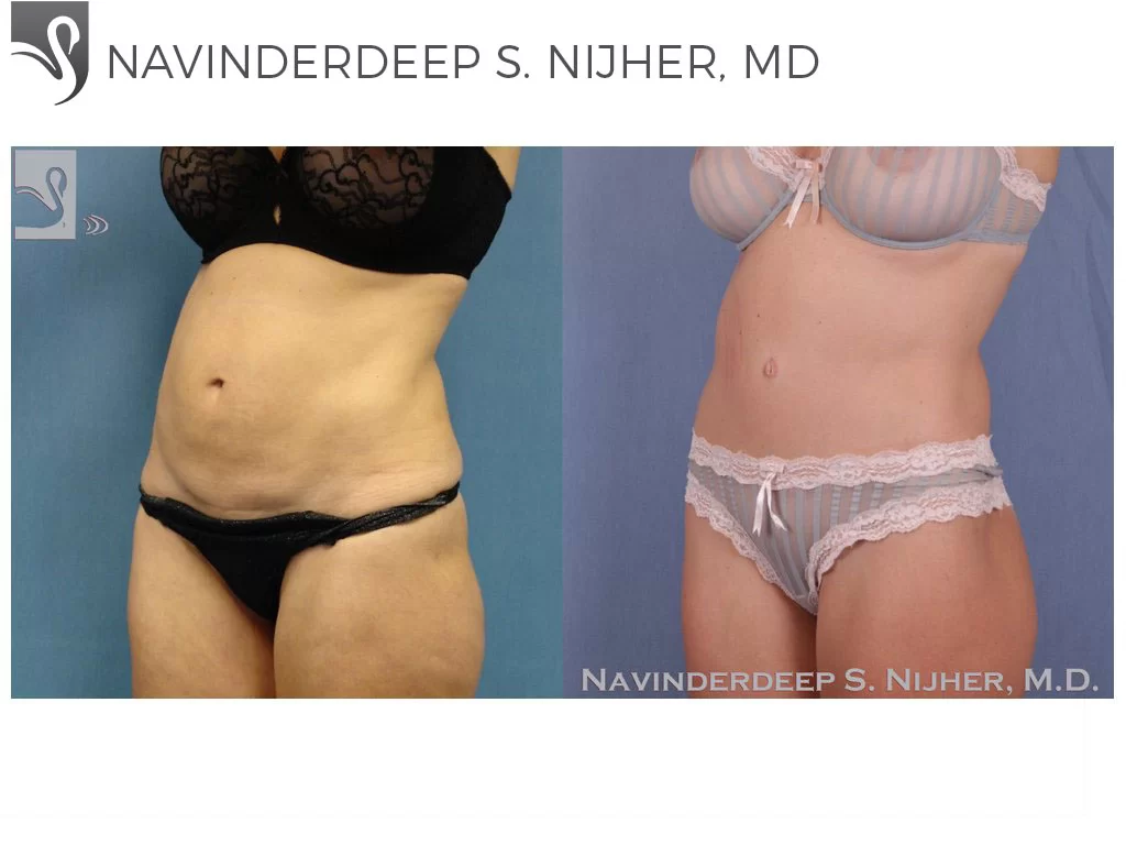 Before and After Image: Abdominoplasty (Tummy Tuck) Case #42736 - left-front-oblique