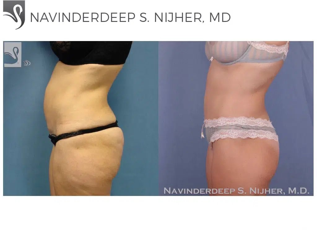 Before and After Image: Abdominoplasty (Tummy Tuck) Case #42736 - left-side