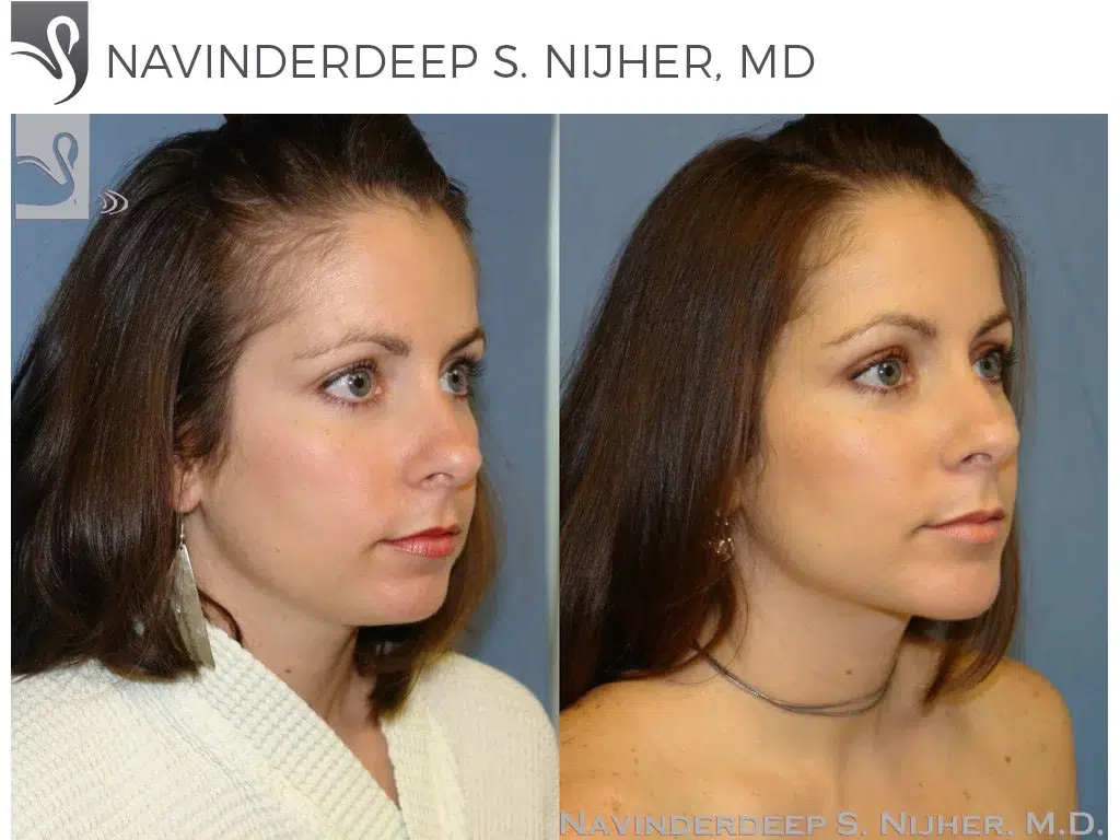 Before and After Image: Facial Implants Case #42871 - right-front-oblique
