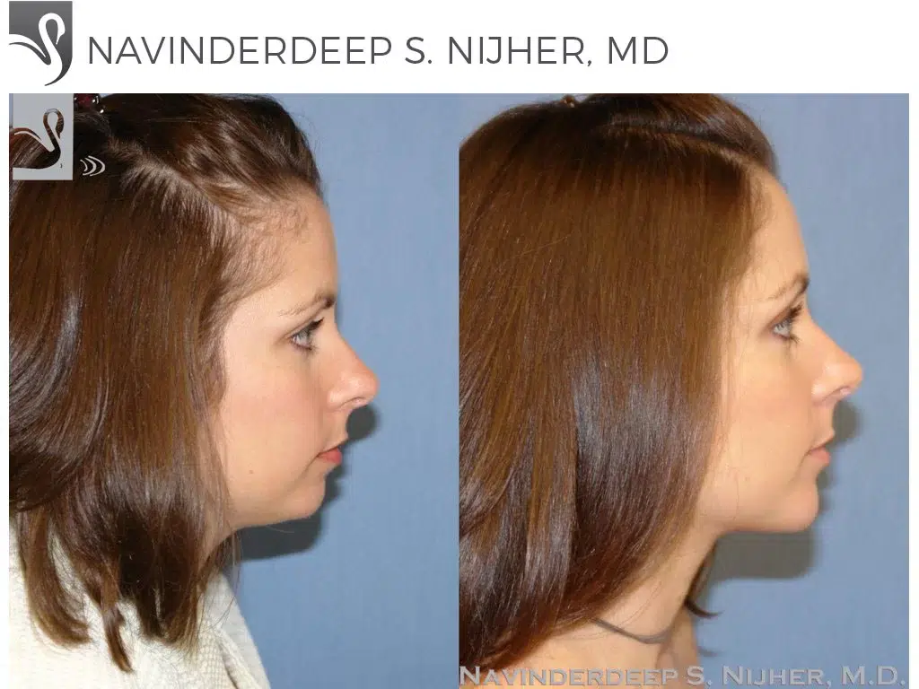 Before and After Image: Facial Implants Case #42871 - right-side