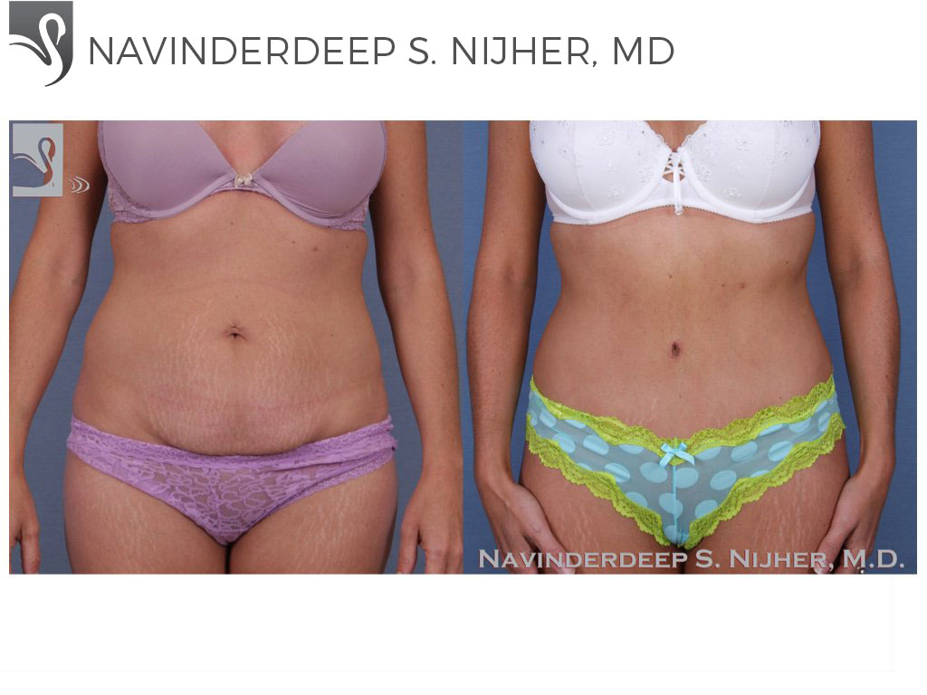 Before and After Image: Abdominoplasty (Tummy Tuck) Case #42981 - front