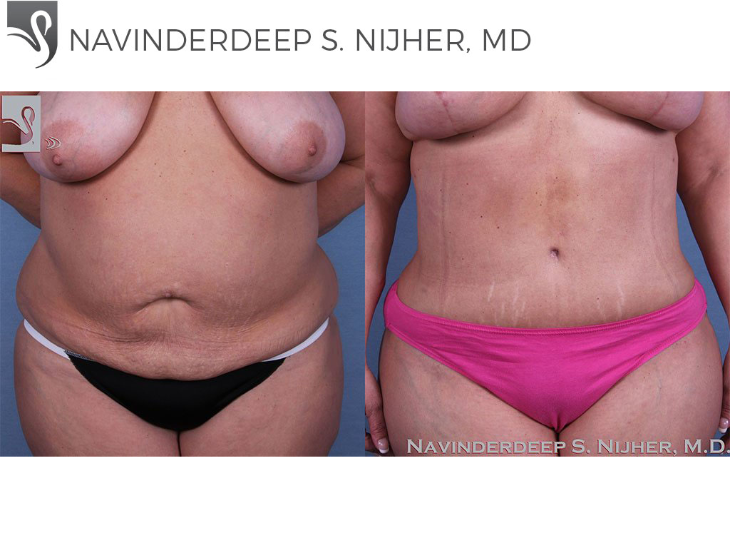 Before and After Image: Abdominoplasty (Tummy Tuck) Case #43158 - front