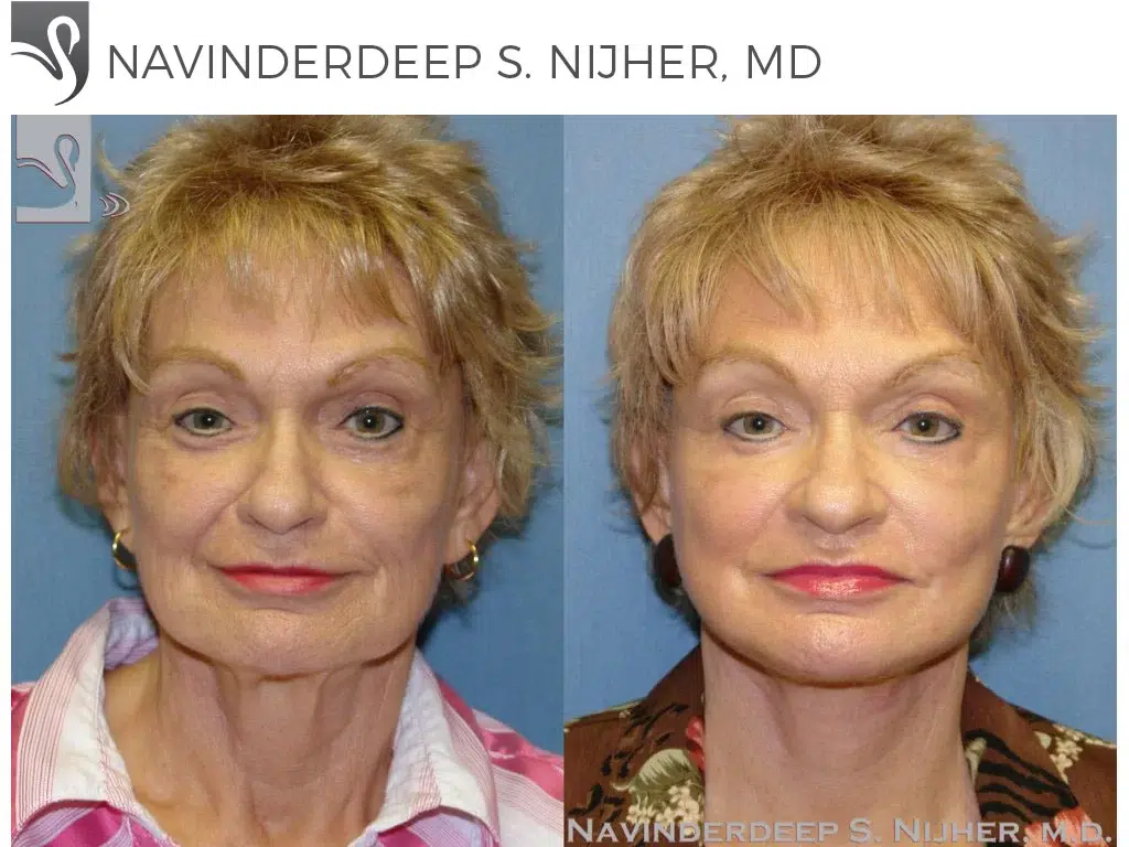 Before and After Image: Face Lift Case #43338 - front