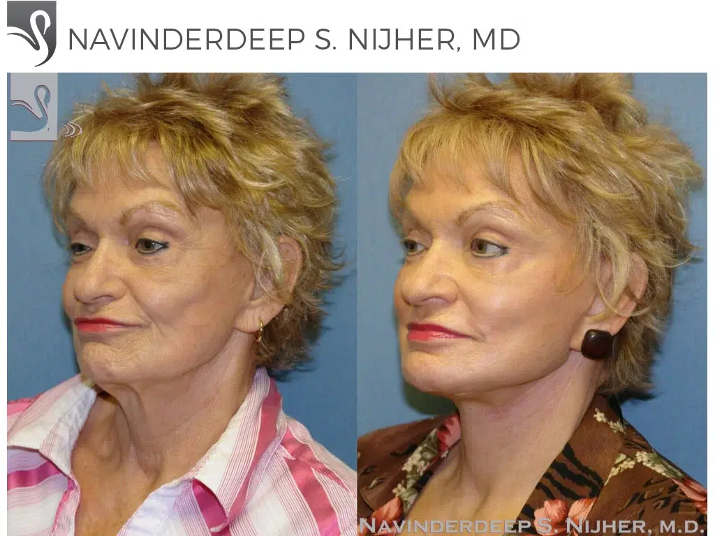 Before and After Image: Face Lift Case #43338 - left-front-oblique