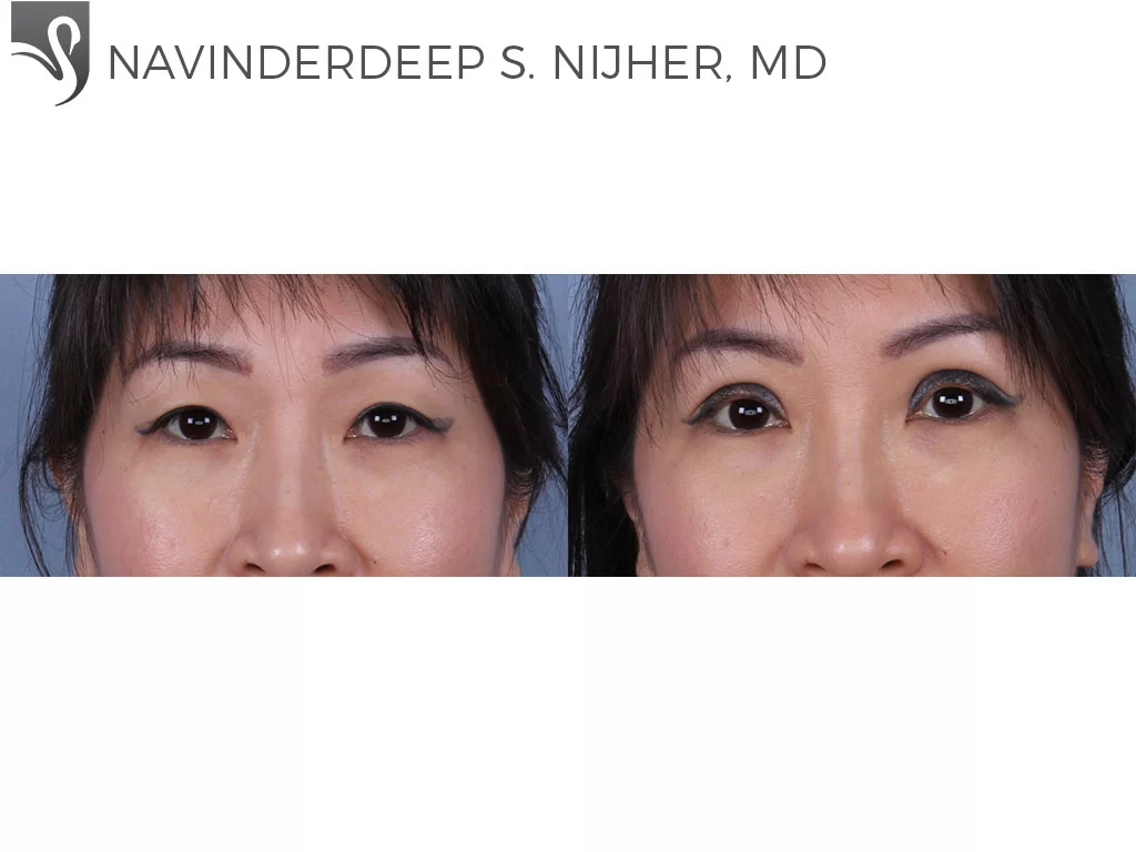 Before and After Image: Eyelid Surgery Case #43478 - front