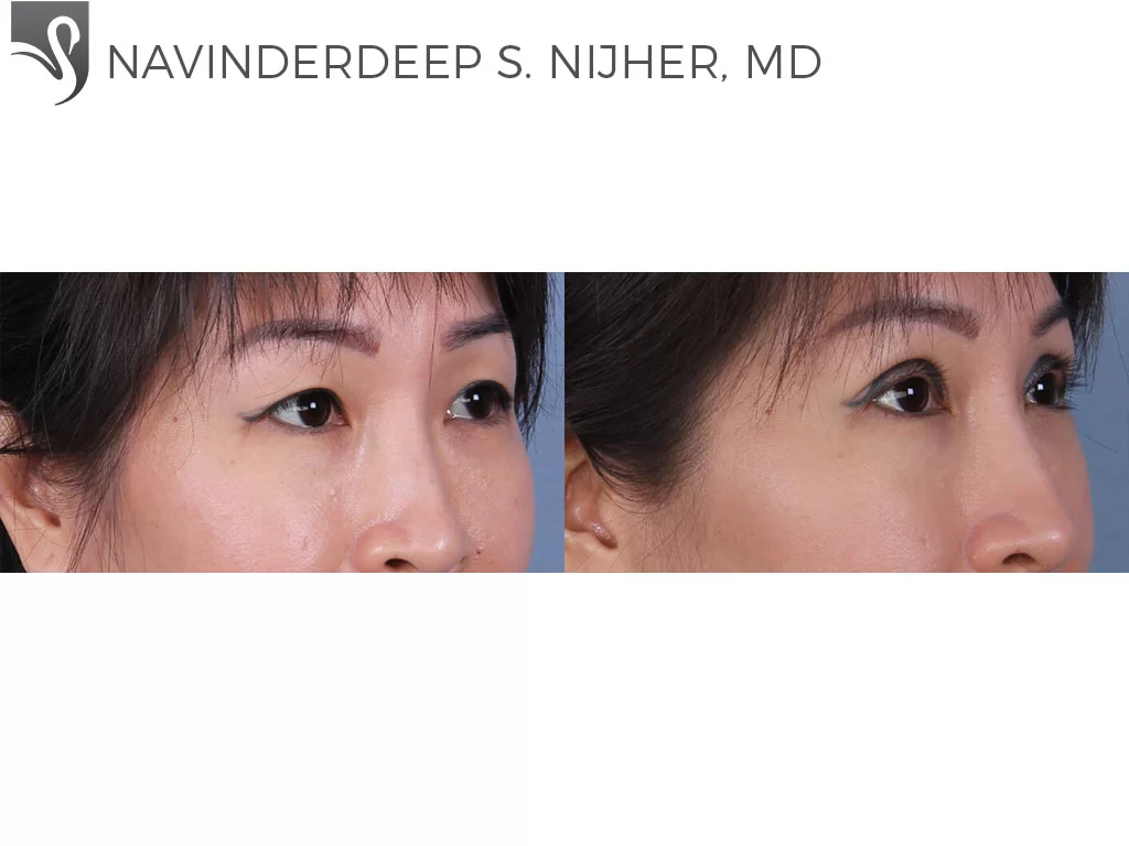 Before and After Image: Eyelid Surgery Case #43478 - right-front-oblique