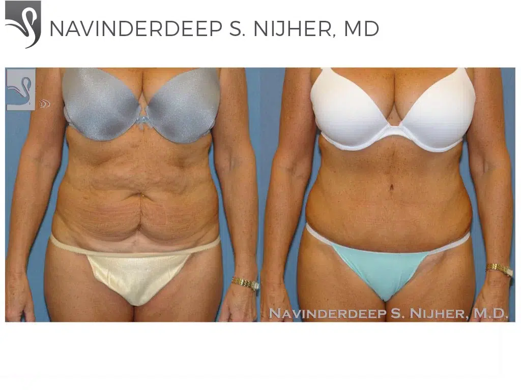 Before and After Image: Abdominoplasty (Tummy Tuck) Case #43576 - front
