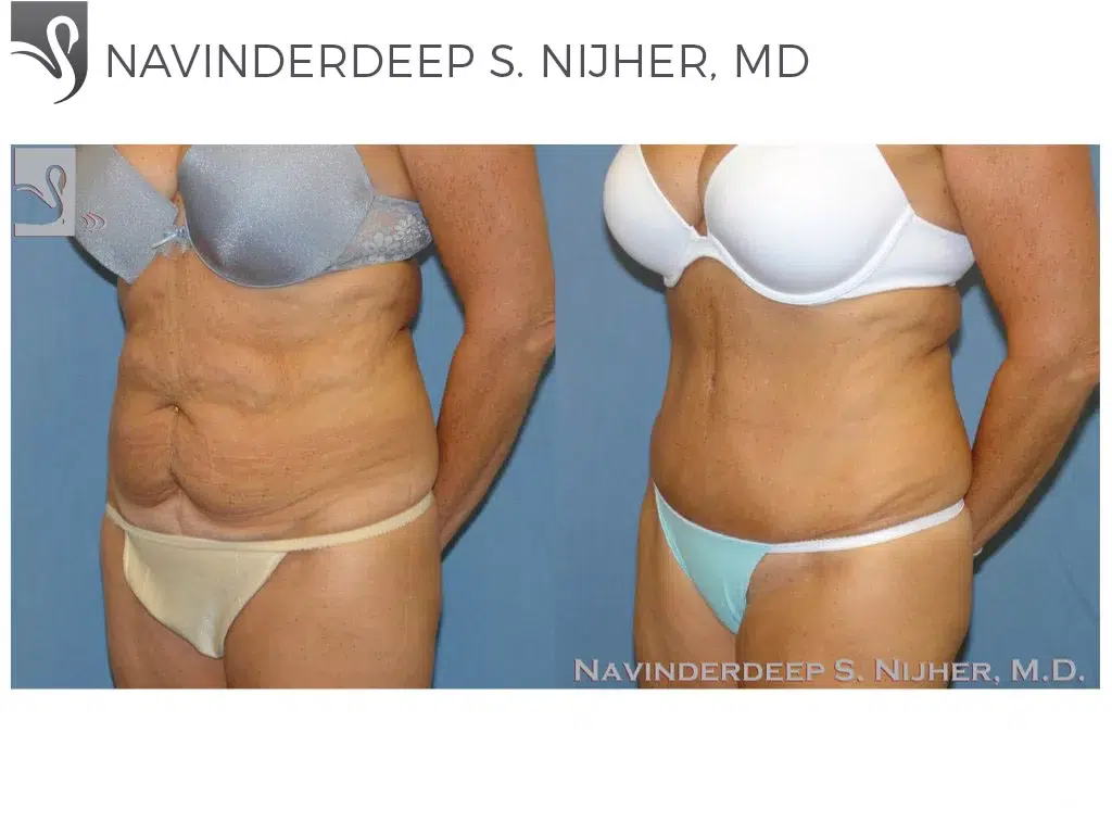Before and After Image: Abdominoplasty (Tummy Tuck) Case #43576 - left-front-oblique