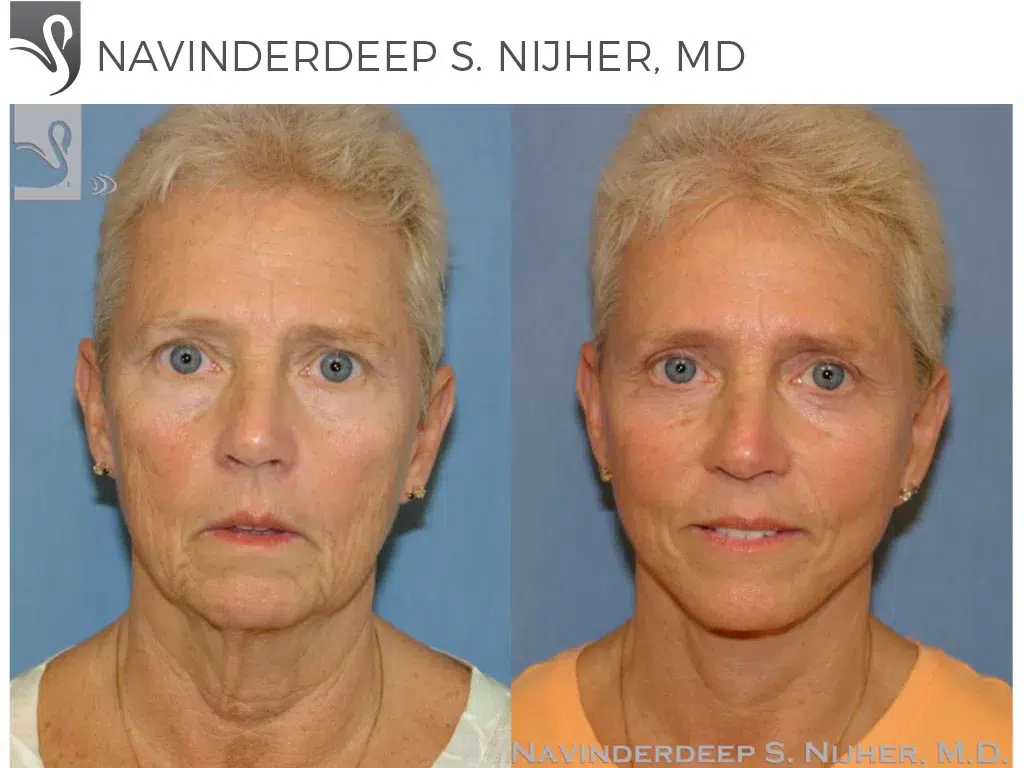Before and After Image: Face Lift Case #43576 - front