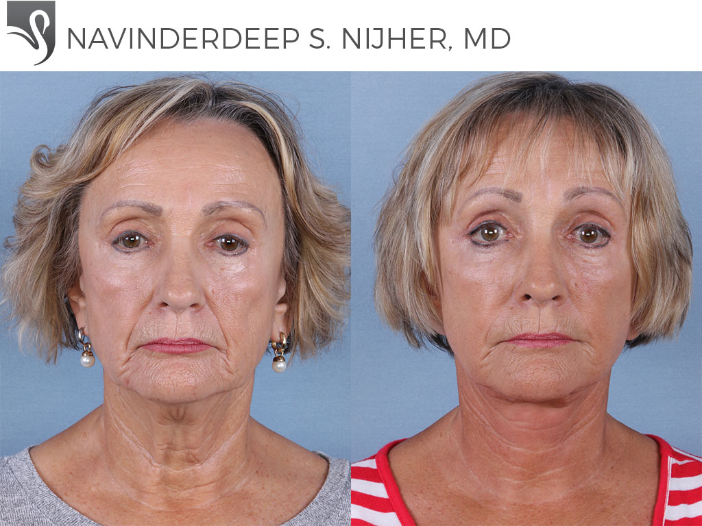 Before and After Image: Face Lift Case #43782 - front