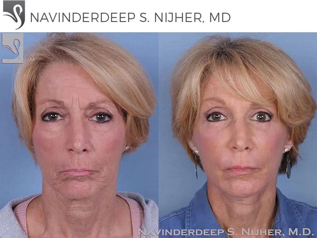 Before and After Image: Face Lift Case #44605 - front