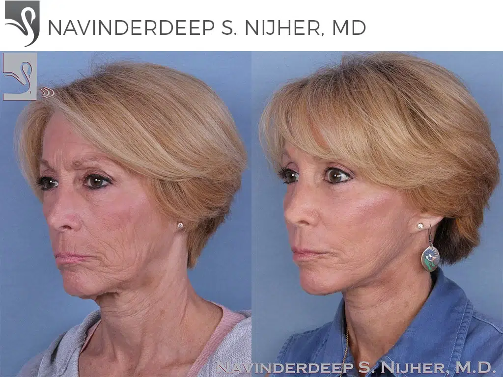 Before and After Image: Face Lift Case #44605 - left-front-oblique
