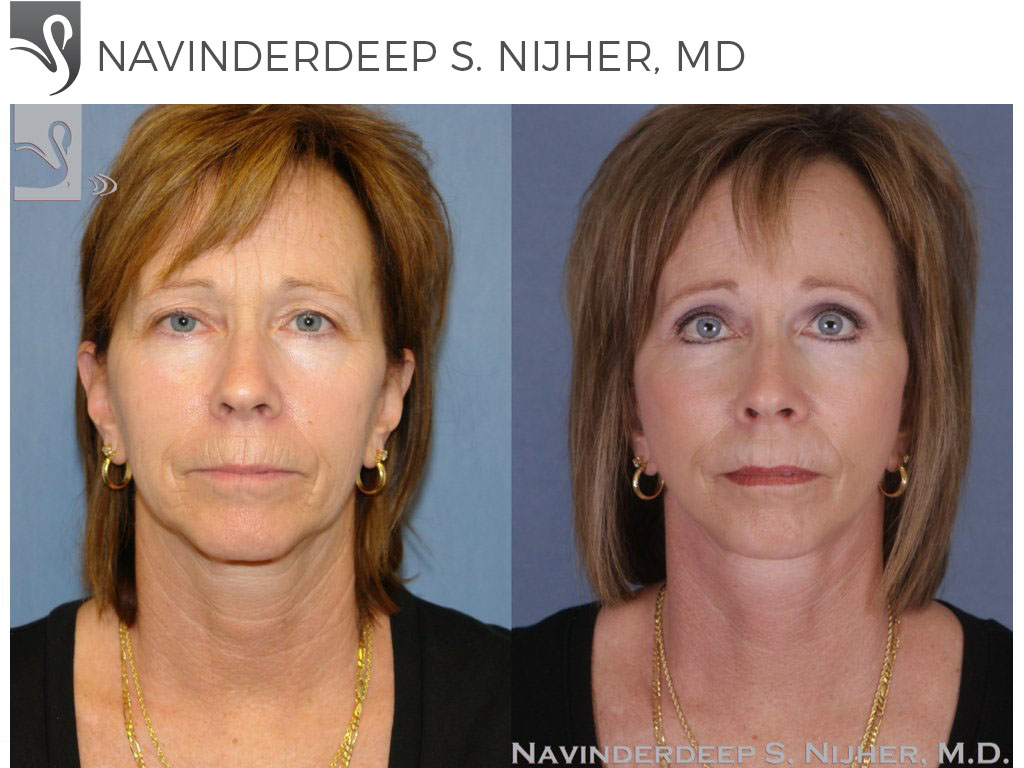 Before and After Image: Brow Lift Case #44620 - front