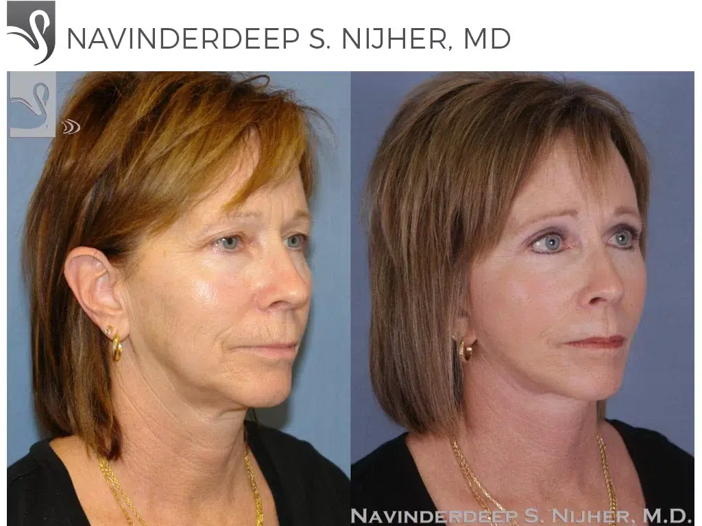 Before and After Image: Brow Lift Case #44620 - right-front-oblique