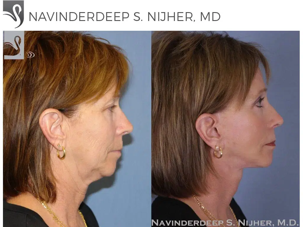 Before and After Image: Brow Lift Case #44620 - right-side