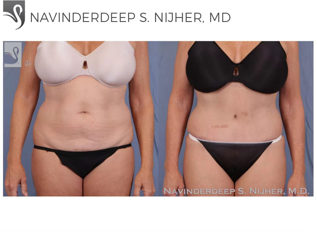 Before and After Image: Abdominoplasty (Tummy Tuck) Case #44856 - front