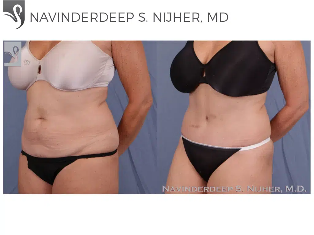 Before and After Image: Abdominoplasty (Tummy Tuck) Case #44856 - left-front-oblique