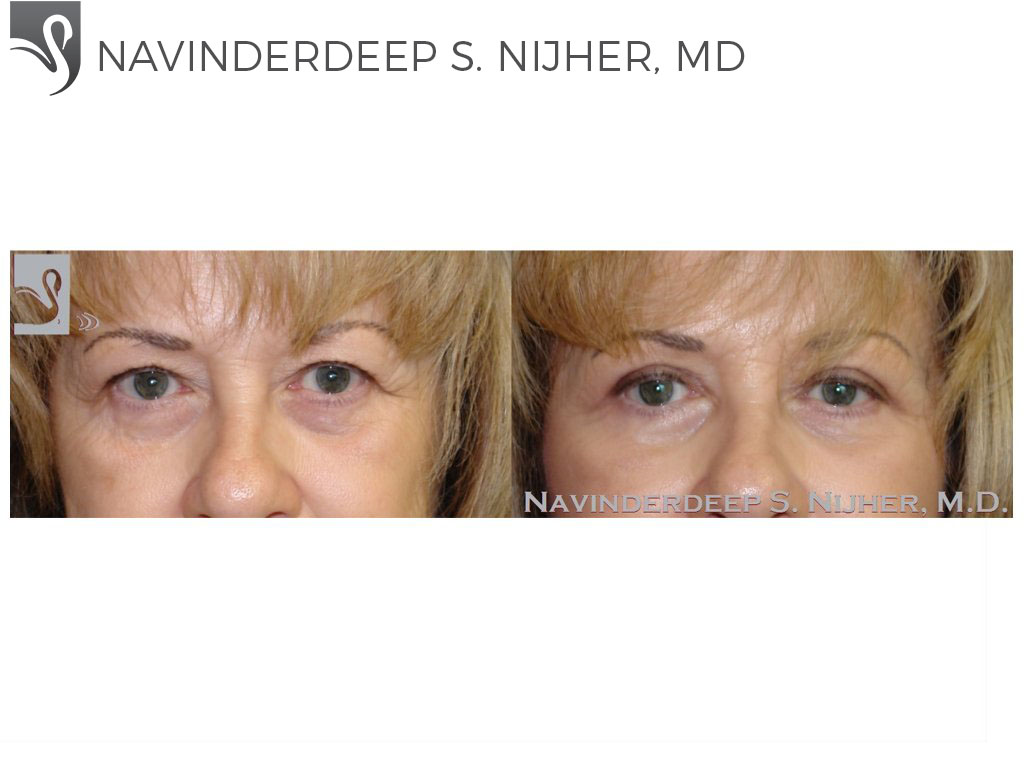 Before and After Image: Eyelid Surgery Case #44894 - front