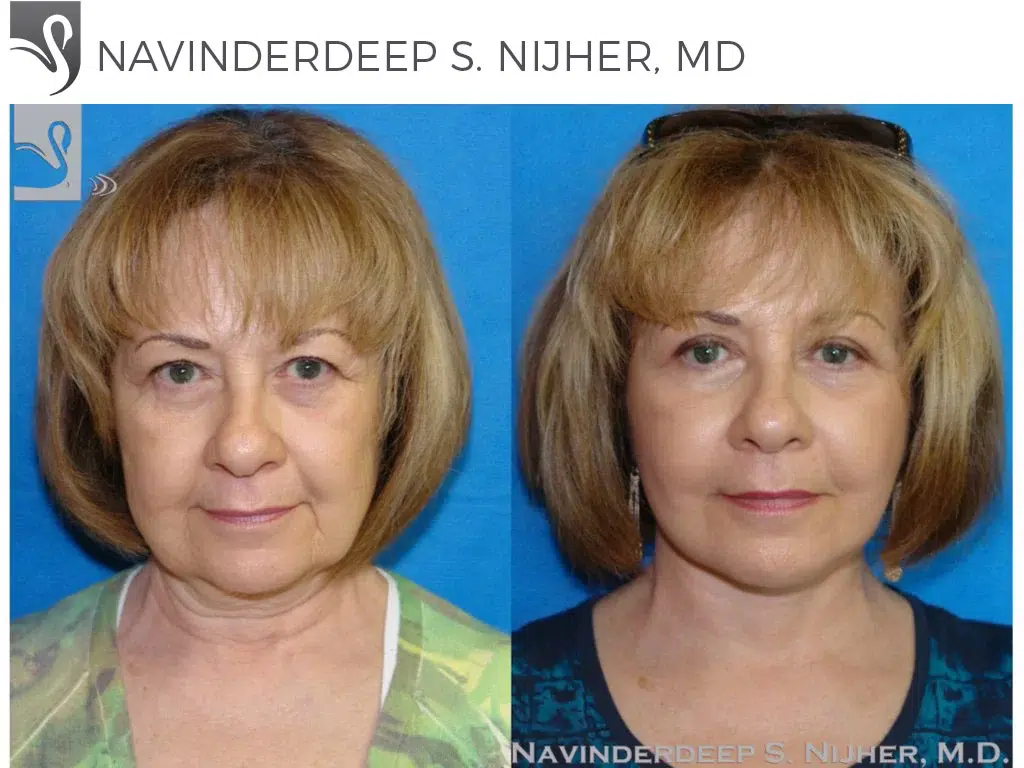 Before and After Image: Face Lift Case #44894 - front