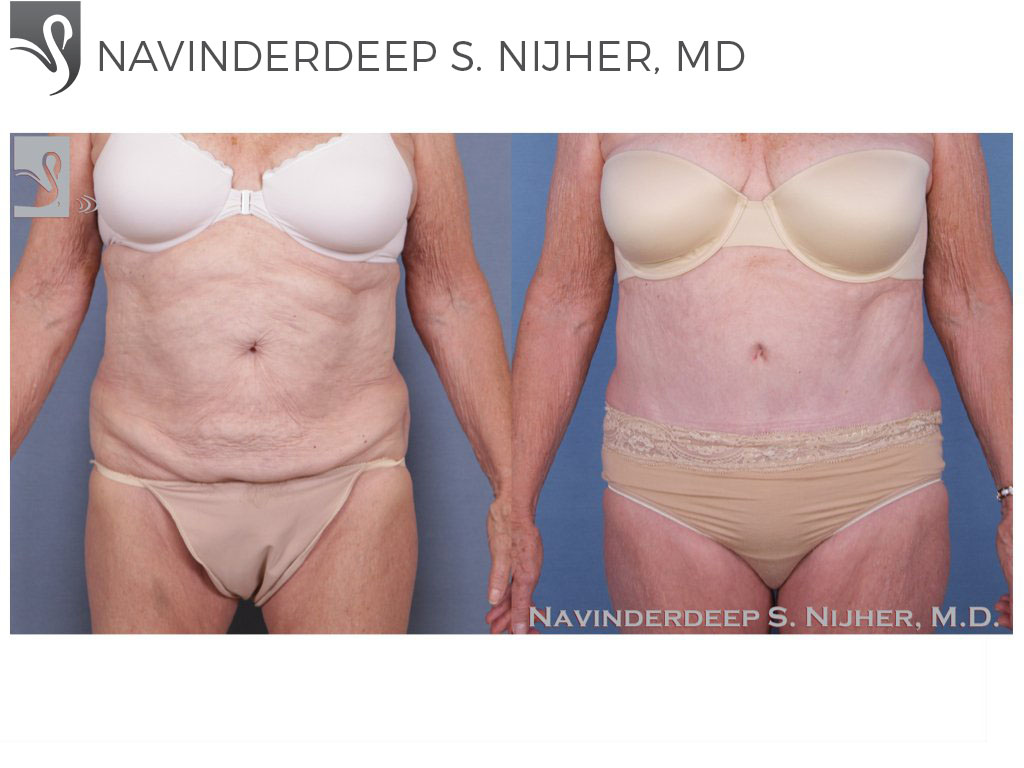 Before and After Image: Abdominoplasty (Tummy Tuck) Case #45721 - front