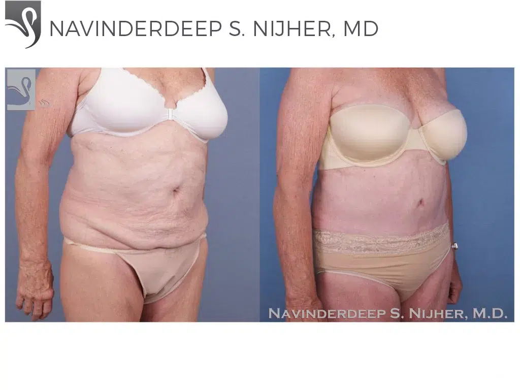 Before and After Image: Abdominoplasty (Tummy Tuck) Case #45721 - right-front-oblique