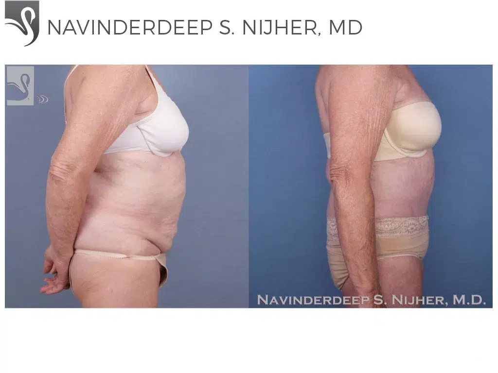 Before and After Image: Abdominoplasty (Tummy Tuck) Case #45721 - right-side