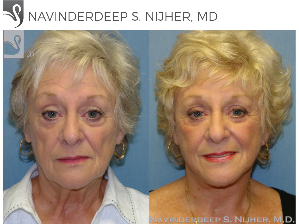 Before and After Image: Face Lift Case #45721 - front