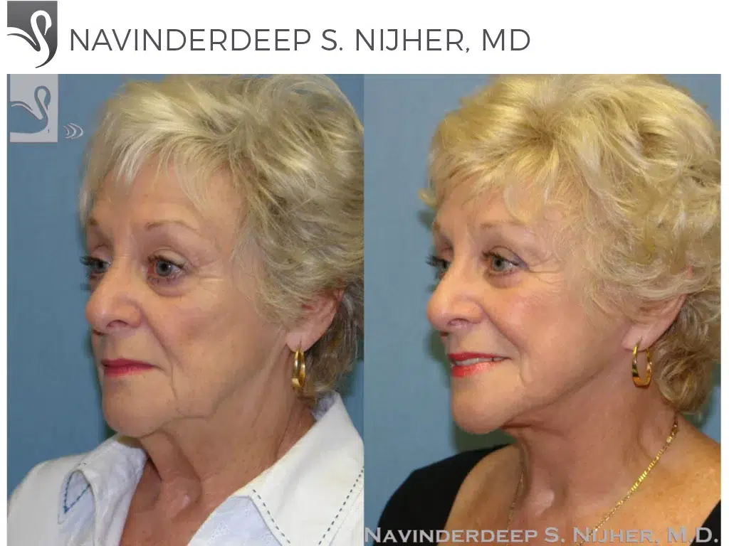 Before and After Image: Face Lift Case #45721 - left-front-oblique