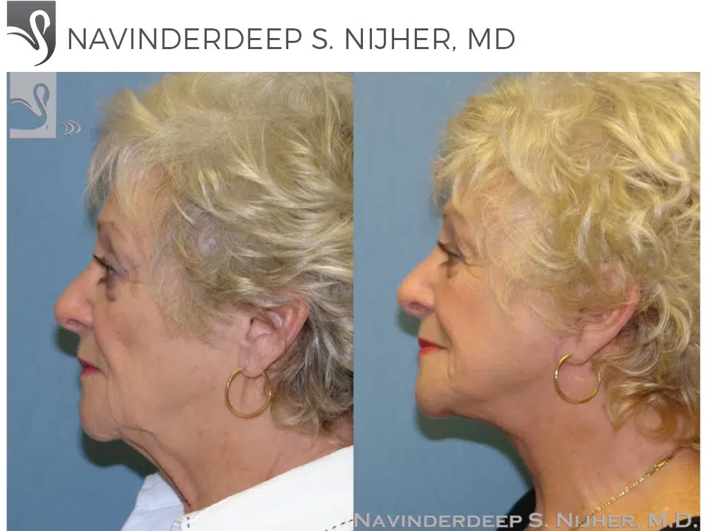 Before and After Image: Face Lift Case #45721 - left-side