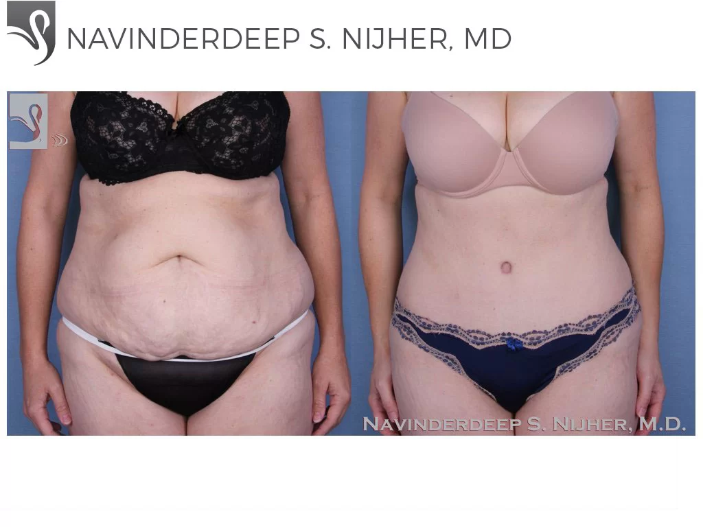 Before and After Image: Abdominoplasty (Tummy Tuck) Case #45864 - front