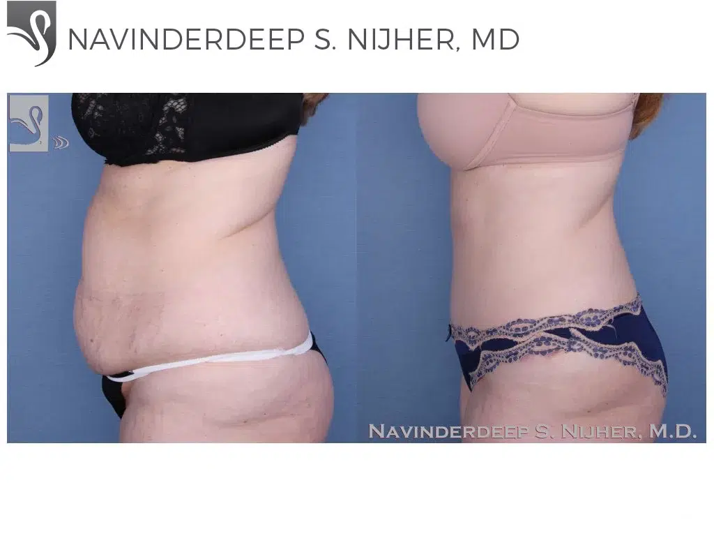 Before and After Image: Abdominoplasty (Tummy Tuck) Case #45864 - left-side