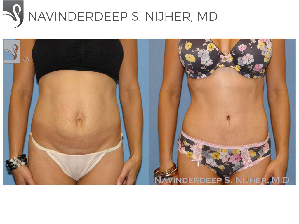 Before and After Image: Abdominoplasty (Tummy Tuck) Case #45952 - front