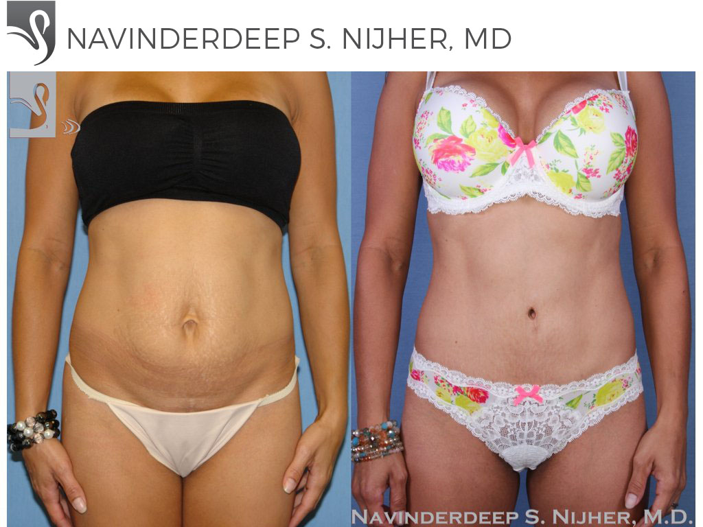 Before and After Image: Mommy Makeover Case #45952 - front