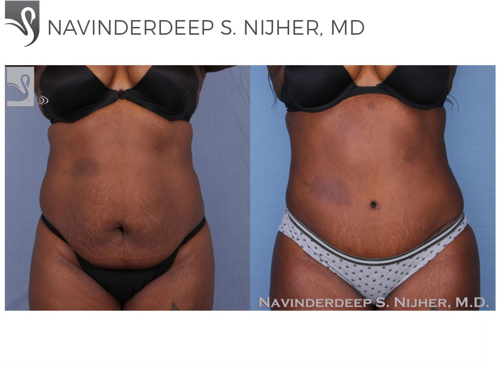 Before and After Image: Abdominoplasty (Tummy Tuck) Case #45986 - front