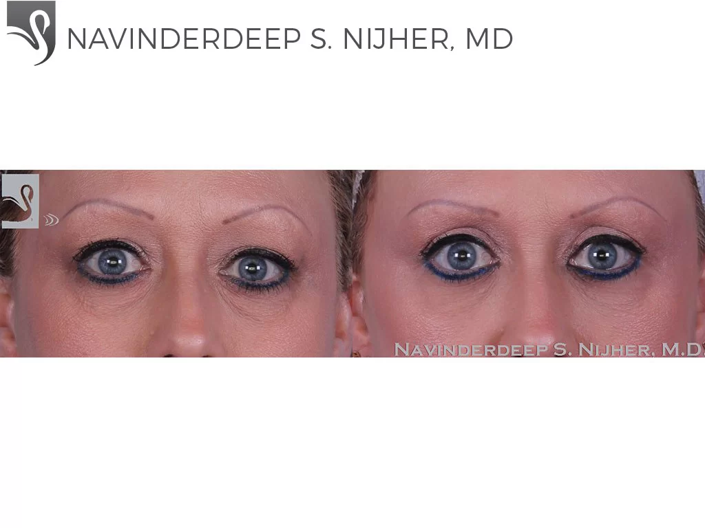 Before and After Image: Eyelid Surgery Case #47153 - front