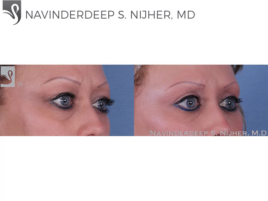 Before and After Image: Eyelid Surgery Case #47153 - right-front-oblique