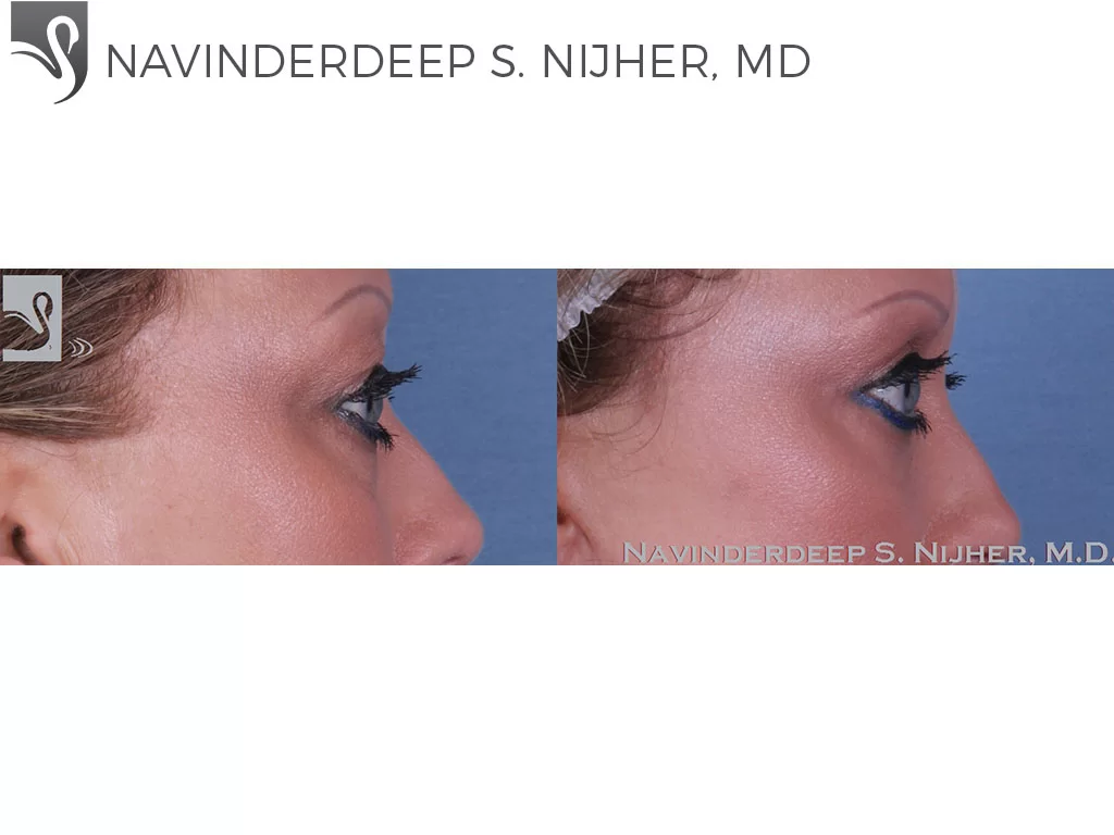 Before and After Image: Eyelid Surgery Case #47153 - right-side