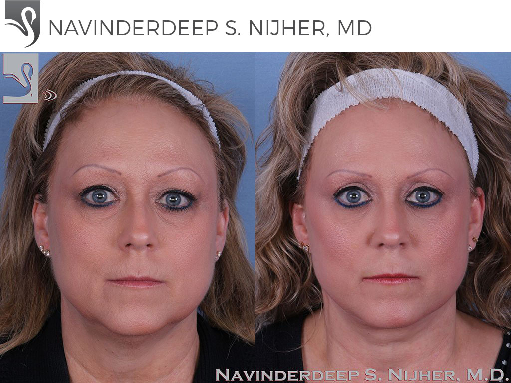 Before and After Image: Face Lift Case #47153 - front