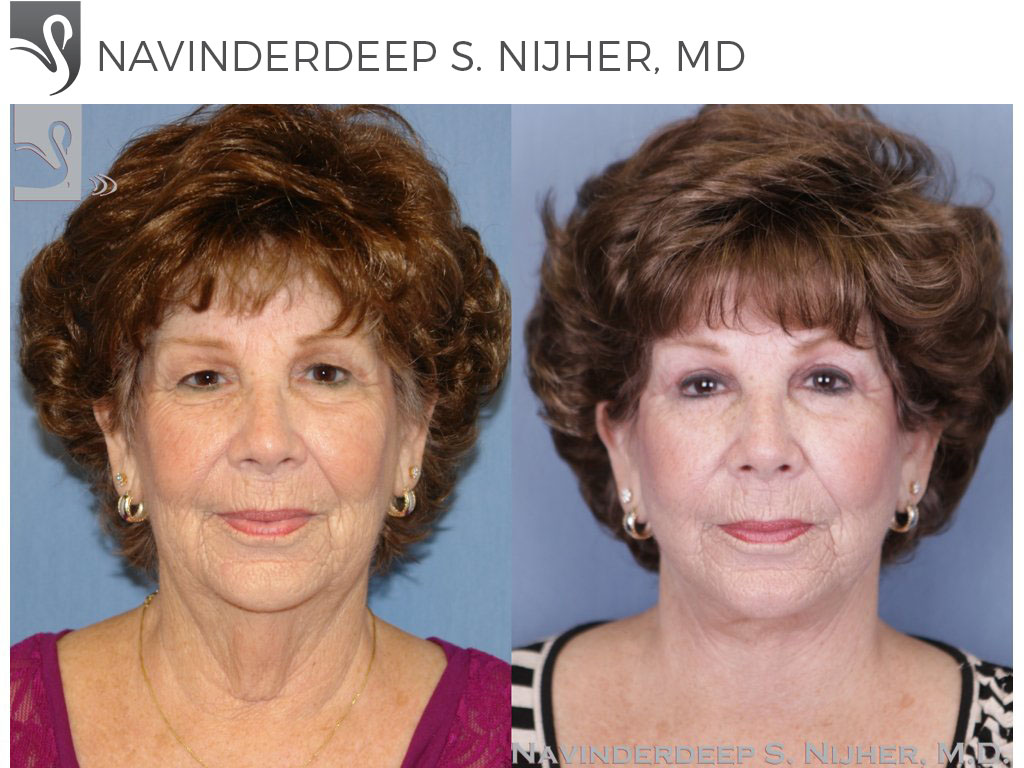 Before and After Image: Face Lift Case #47303 - front
