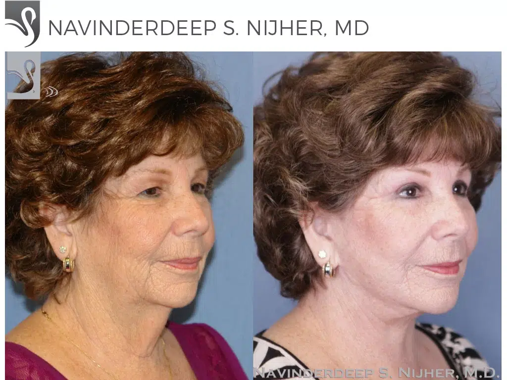 Before and After Image: Face Lift Case #47303 - right-front-oblique