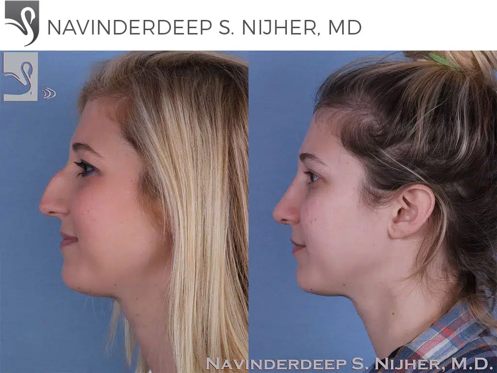 Before and After Image: Rhinoplasty Case #47345 - left-side