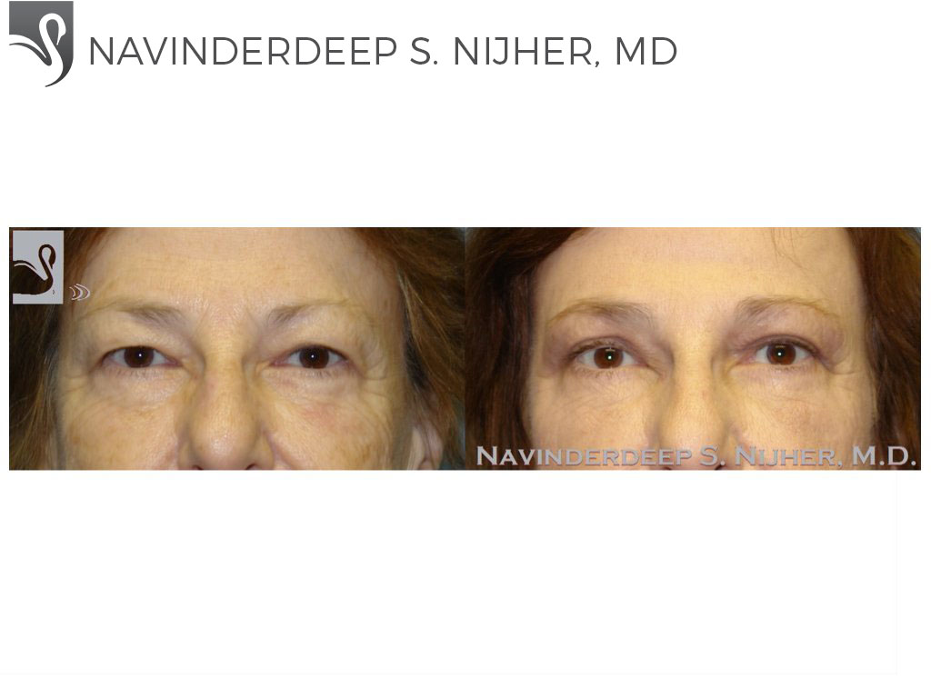 Before and After Image: Eyelid Surgery Case #47695 - front