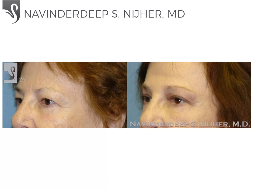 Before and After Image: Eyelid Surgery Case #47695 - left-front-oblique