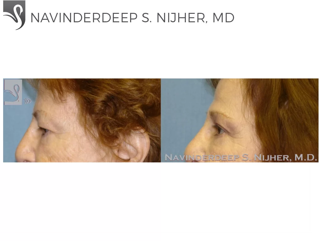 Before and After Image: Eyelid Surgery Case #47695 - left-side
