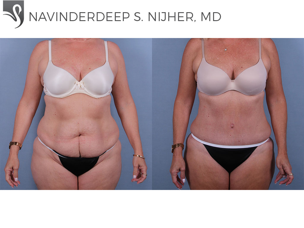 Before and After Image: Abdominoplasty (Tummy Tuck) Case #47716 - front