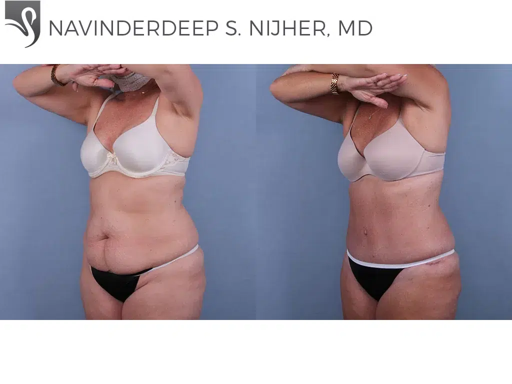 Before and After Image: Abdominoplasty (Tummy Tuck) Case #47716 - left-front-oblique