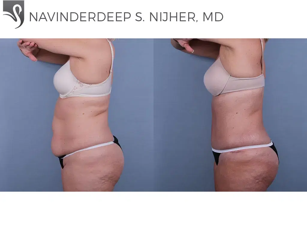 Before and After Image: Abdominoplasty (Tummy Tuck) Case #47716 - left-side