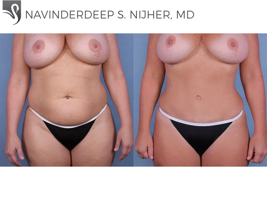 Before and After Image: Abdominoplasty (Tummy Tuck) Case #47923 - front