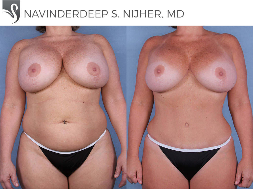 Before and After Image: Mommy Makeover Case #47923 - front