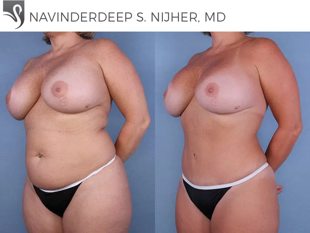 Before and After Image: Mommy Makeover Case #47923 - left-front-oblique